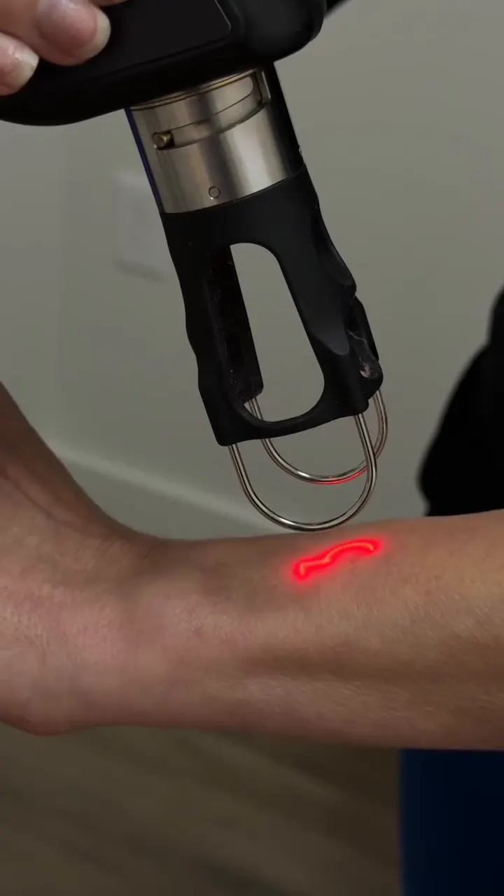 A laser handpiece with its red aiming beam on a client's forearm during a treatment at GLO Ocala